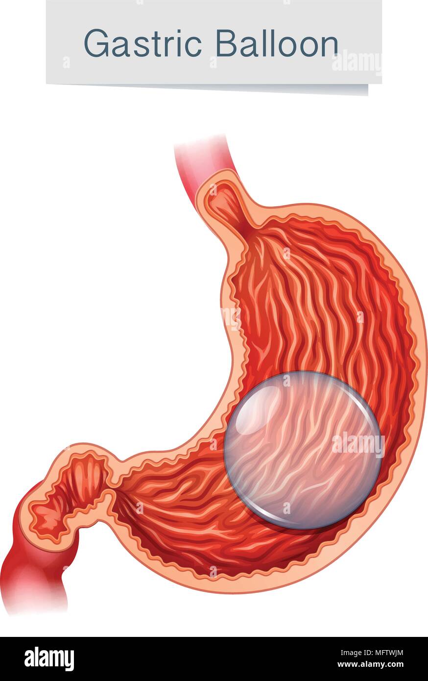 Anatomy Medical Vector Gastric Balloon illustration Stock Vector