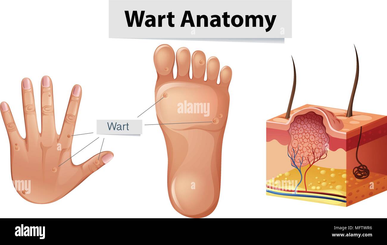 Human Anatomy Wart on Hand and Foot illustration Stock Vector