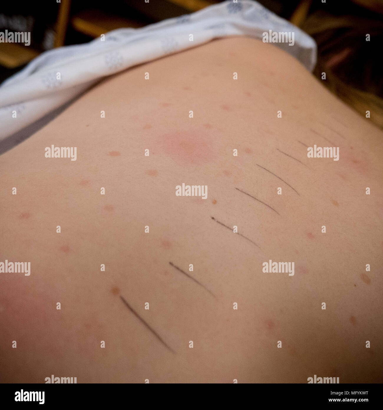 skin prick allergy test on the back of a 13 yo girl Stock Photo Alamy