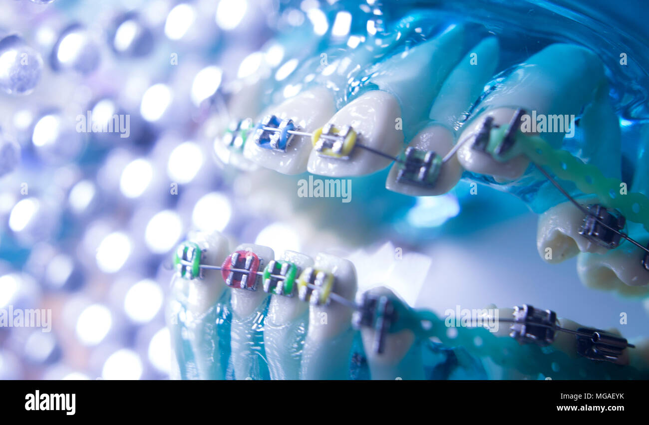 Dental teeth retainers metal aligners brackets to straighten teeth in orthodontic dentistry