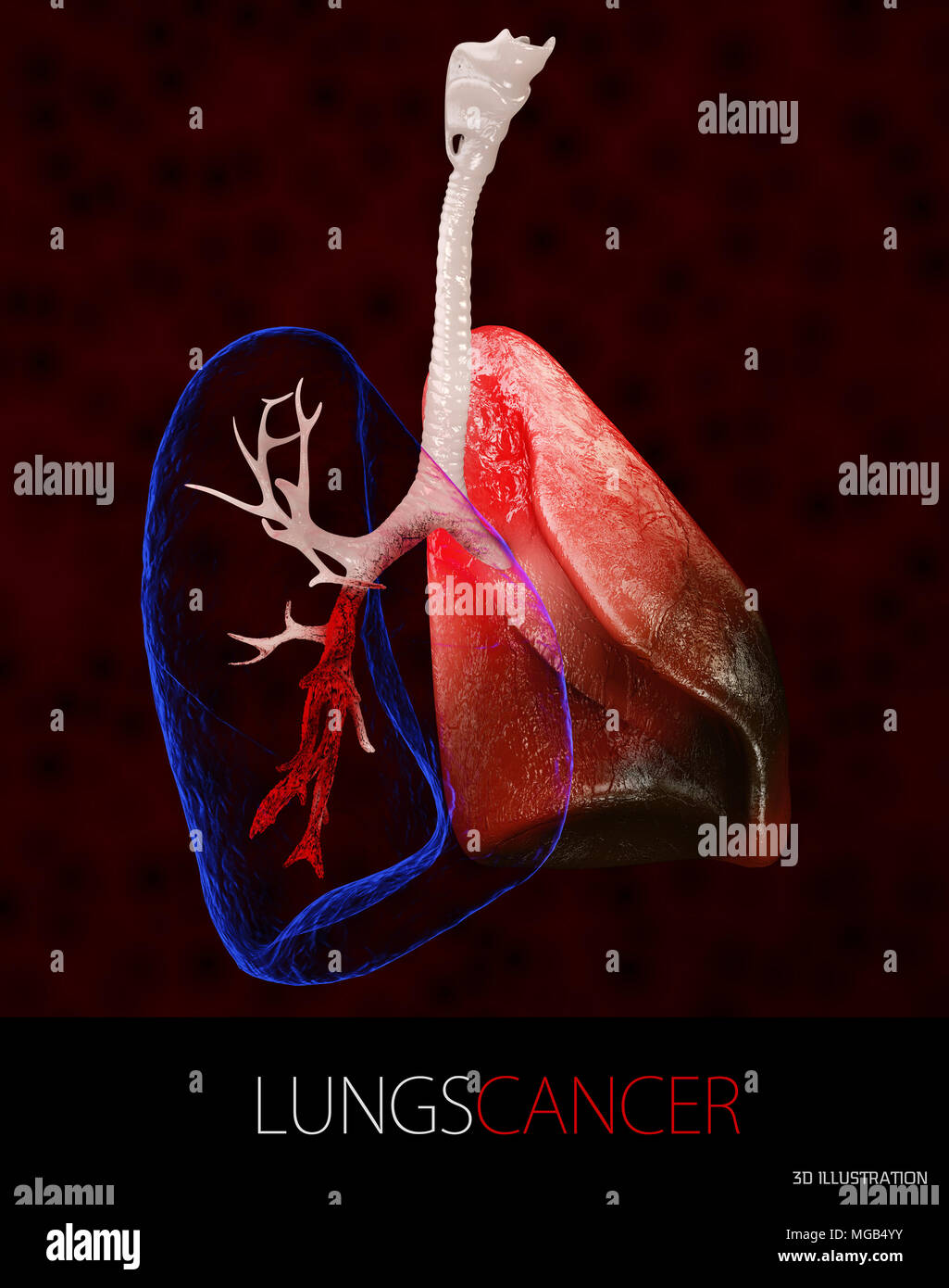 3d Illustration of Lung cancer, pleural effusion isolated black. Stock Photo