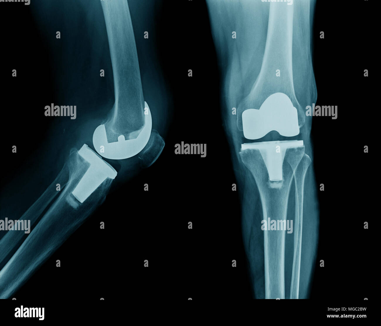 x-ray hip replacement or total knee arthroplasty AP and lateral view Stock Photo