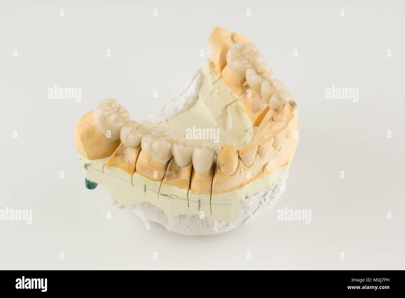 artificial dental structures made of ceramics for restoration of