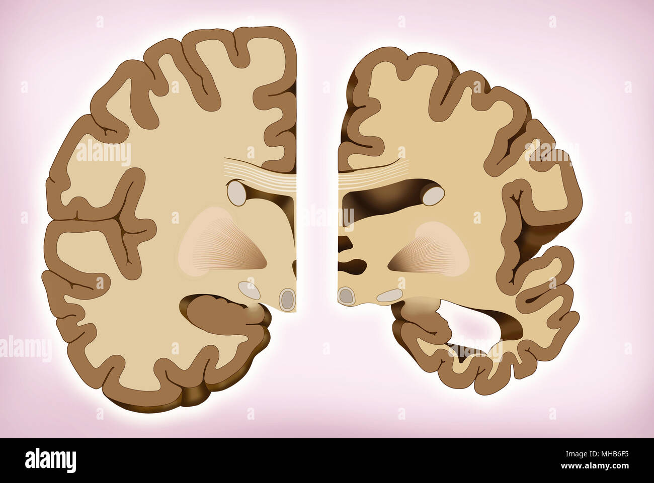 Brain difference in Alzheimer's. Stock Photo