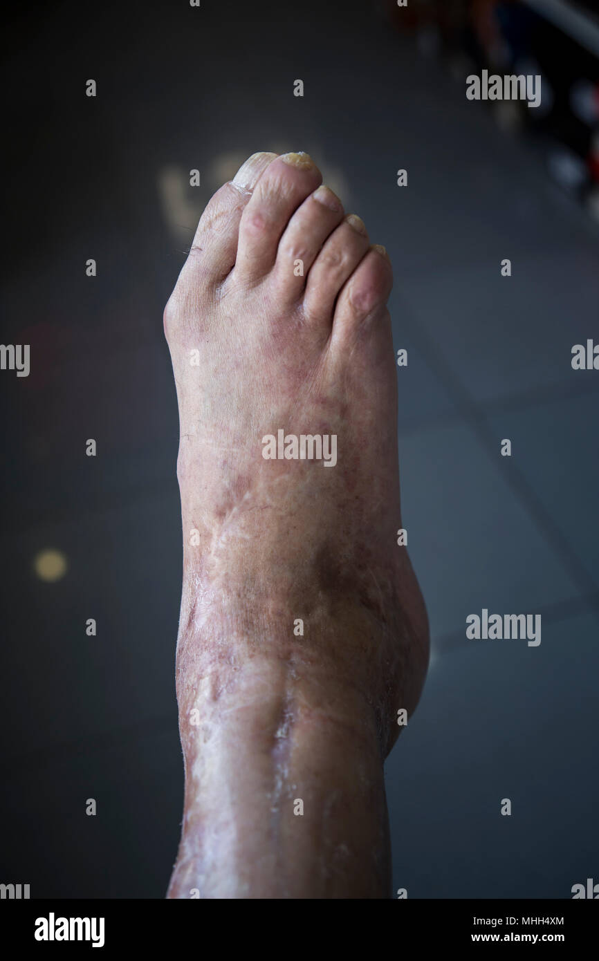 Psoriasis foot hi-res stock photography and images - Alamy