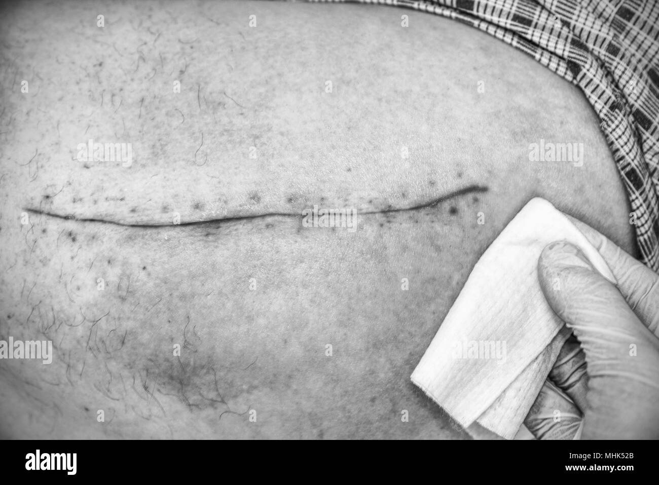 Hip Wound High Resolution Stock Photography And Images Alamy