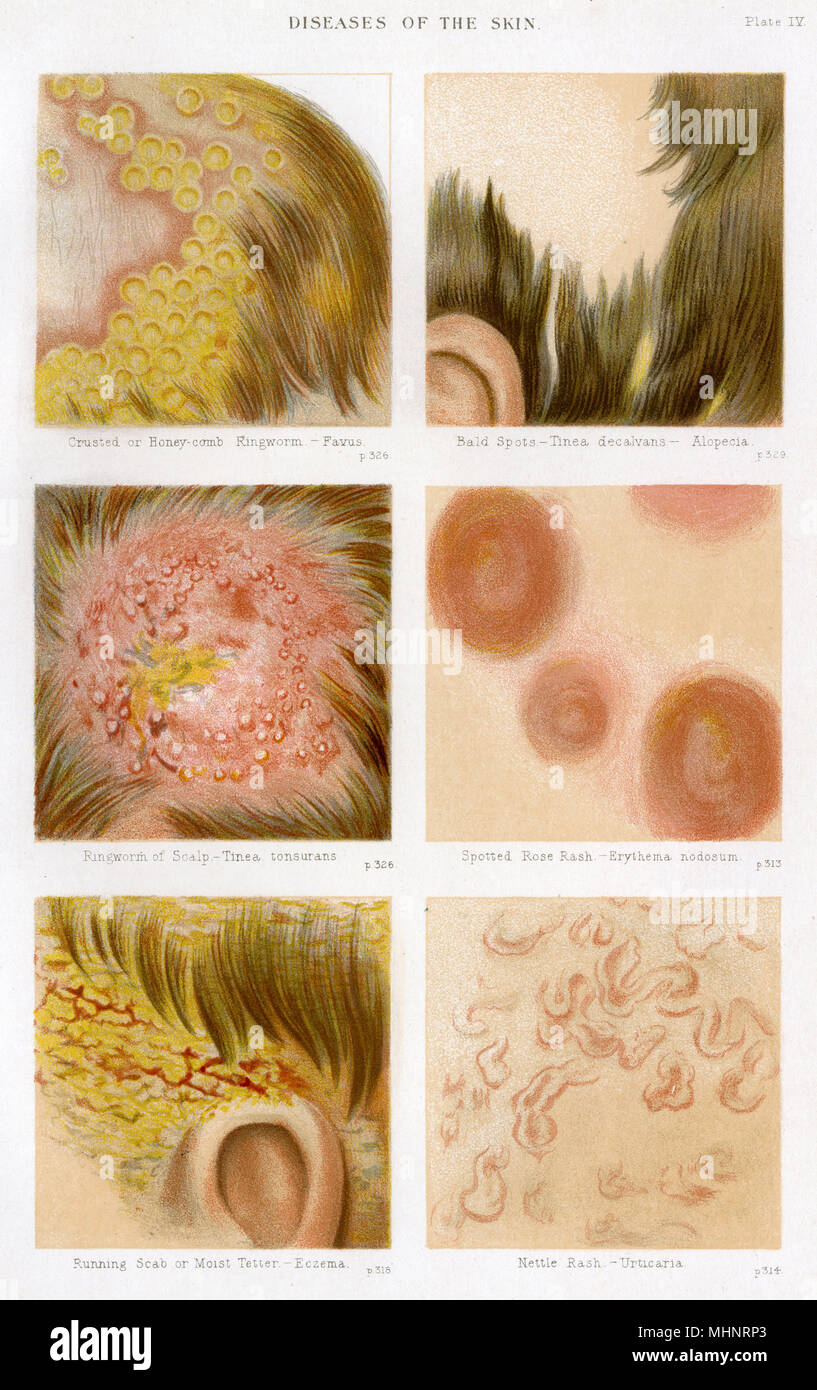 Diseases of the Skin - Plate 4 Stock Photo