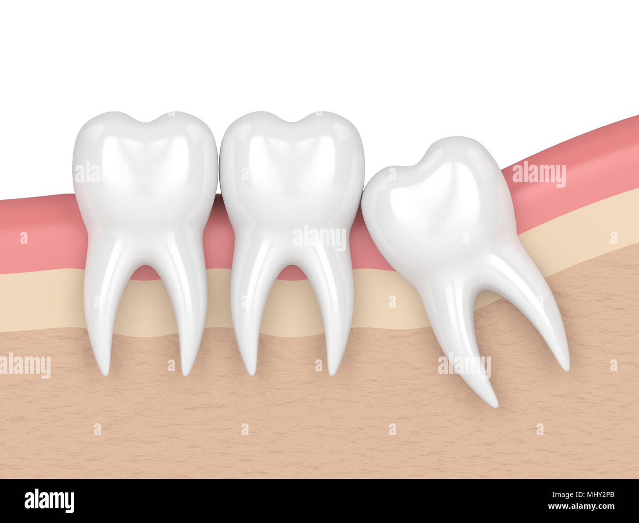 3d render of teeth with wisdom mesial impaction. Concept of different types of wisdom teeth impactions. Stock Photo