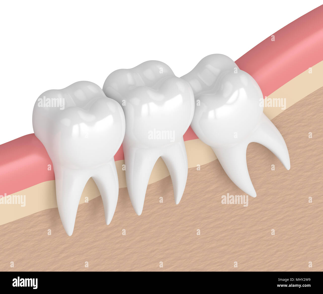 3d render of teeth with wisdom mesial impaction. Concept of different