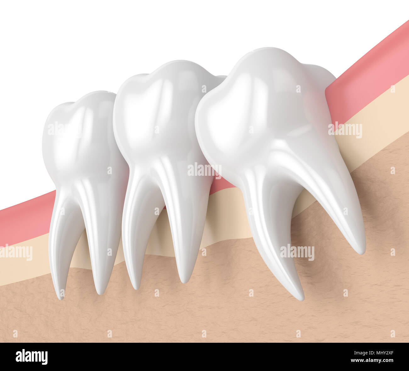 3d render of teeth with wisdom mesial impaction. Concept of different types of wisdom teeth impactions. Stock Photo