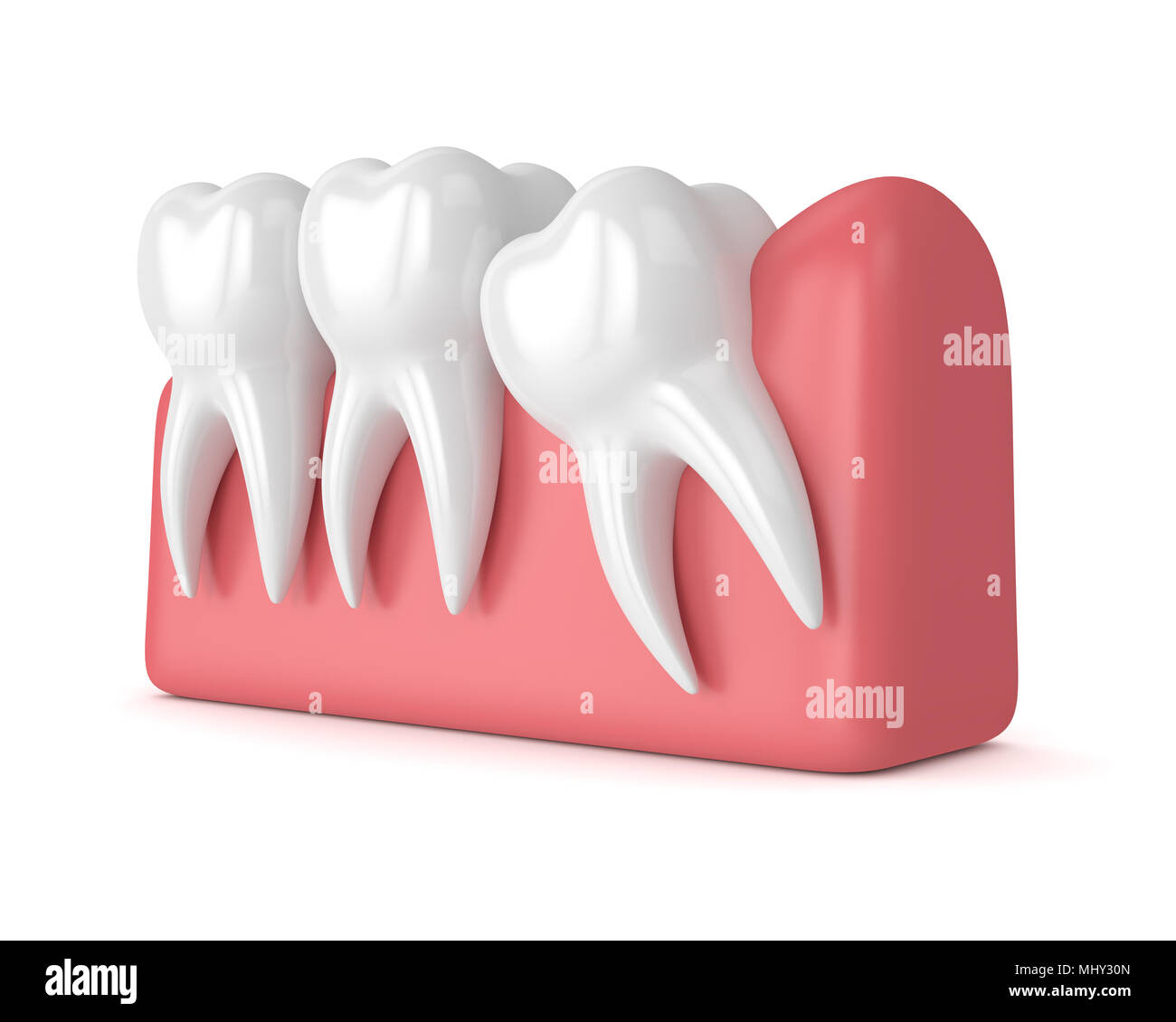 3d render of teeth with wisdom mesial impaction over white background. Concept of different types of wisdom teeth impactions. Stock Photo