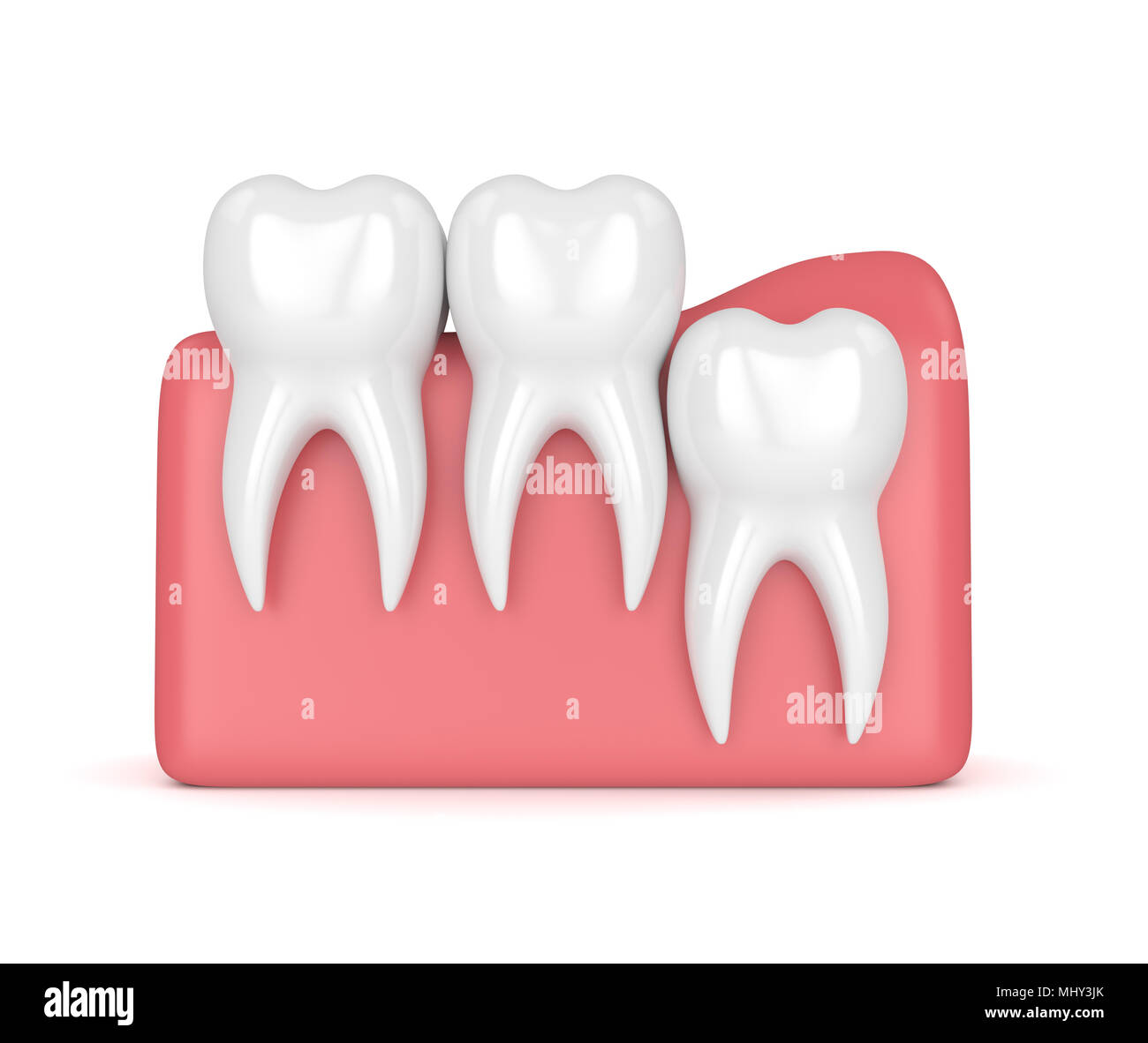 3d render of teeth with wisdom vertical impaction over white background