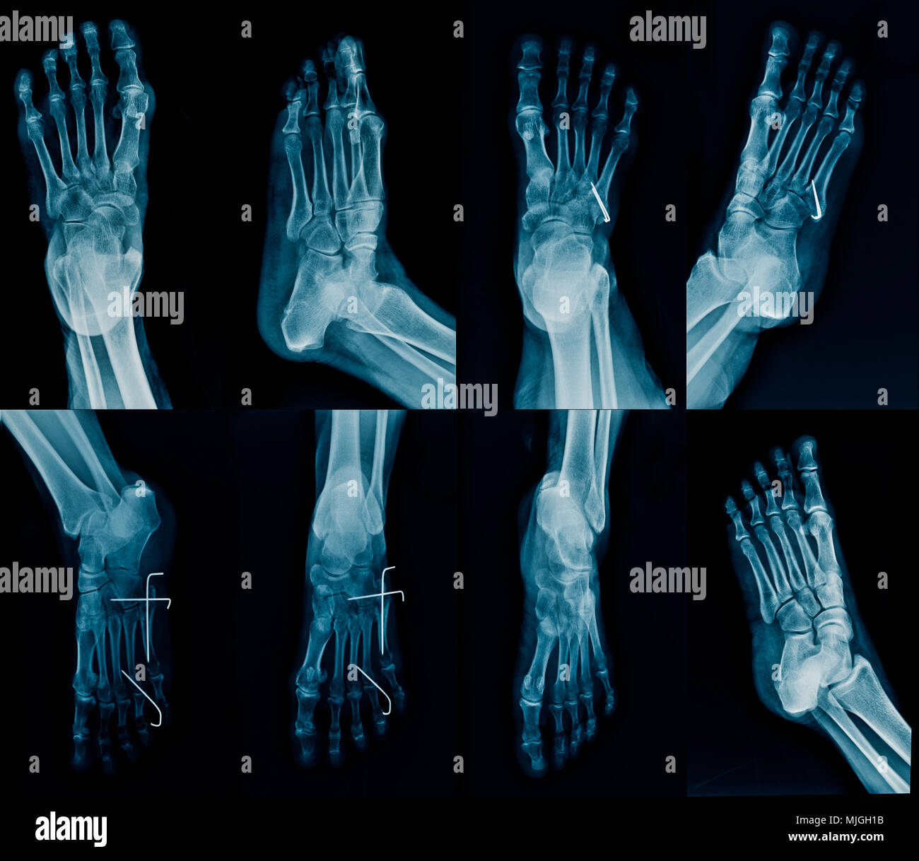 collection foot x-ray multi view, high qulity foot x-ray with k-wine fixation Stock Photo