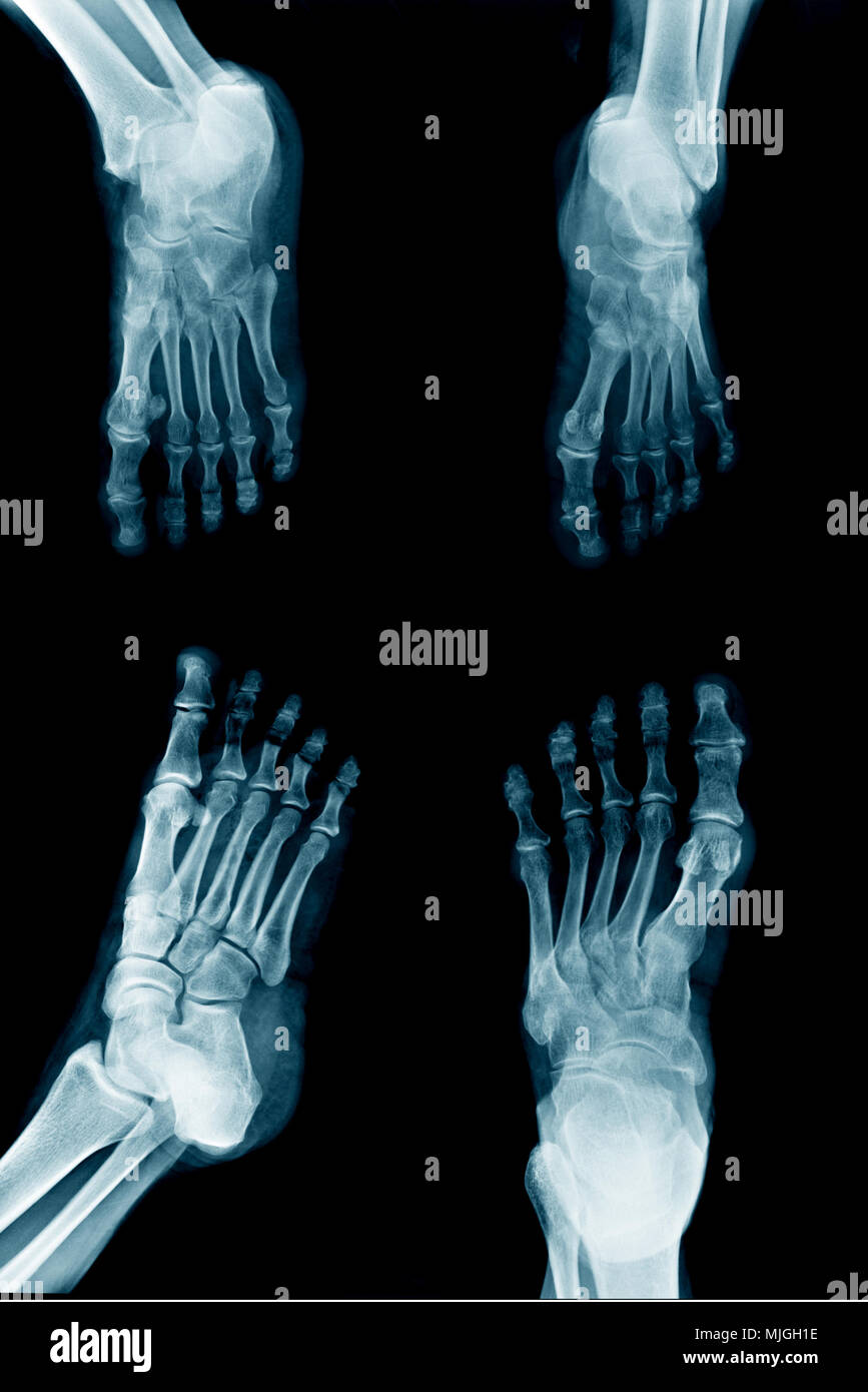 collection foot x-ray multi view Stock Photo