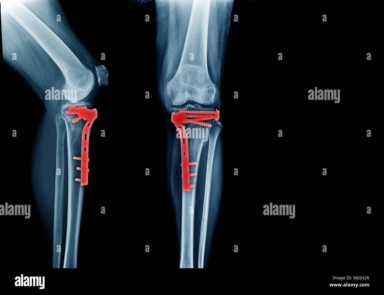 fracture tibia bone and post operation fixation anterior and lateral view x-ray Stock Photo
