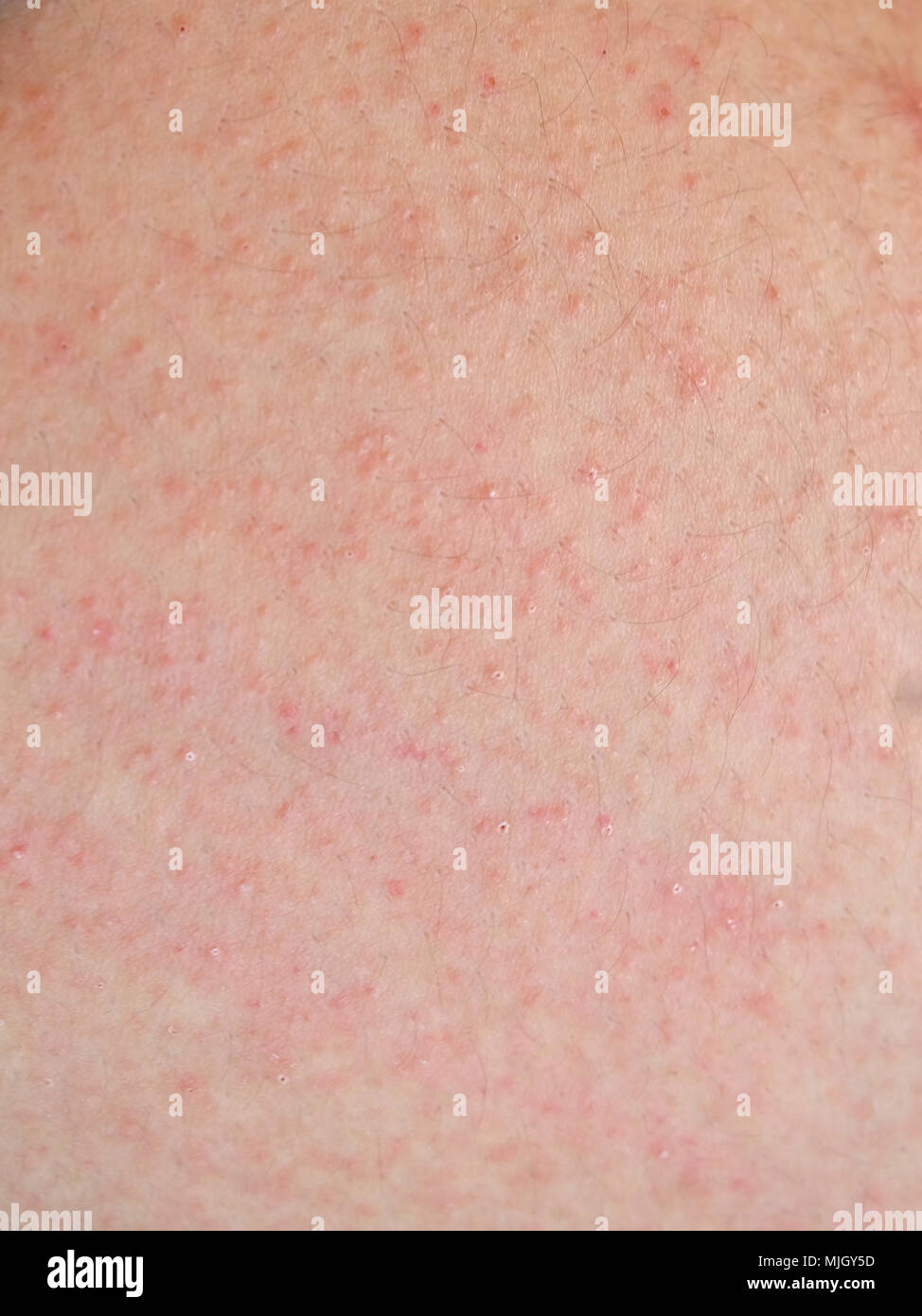 Allergic Rash Dermatitis Skin Of Patient Stock Photo Alamy