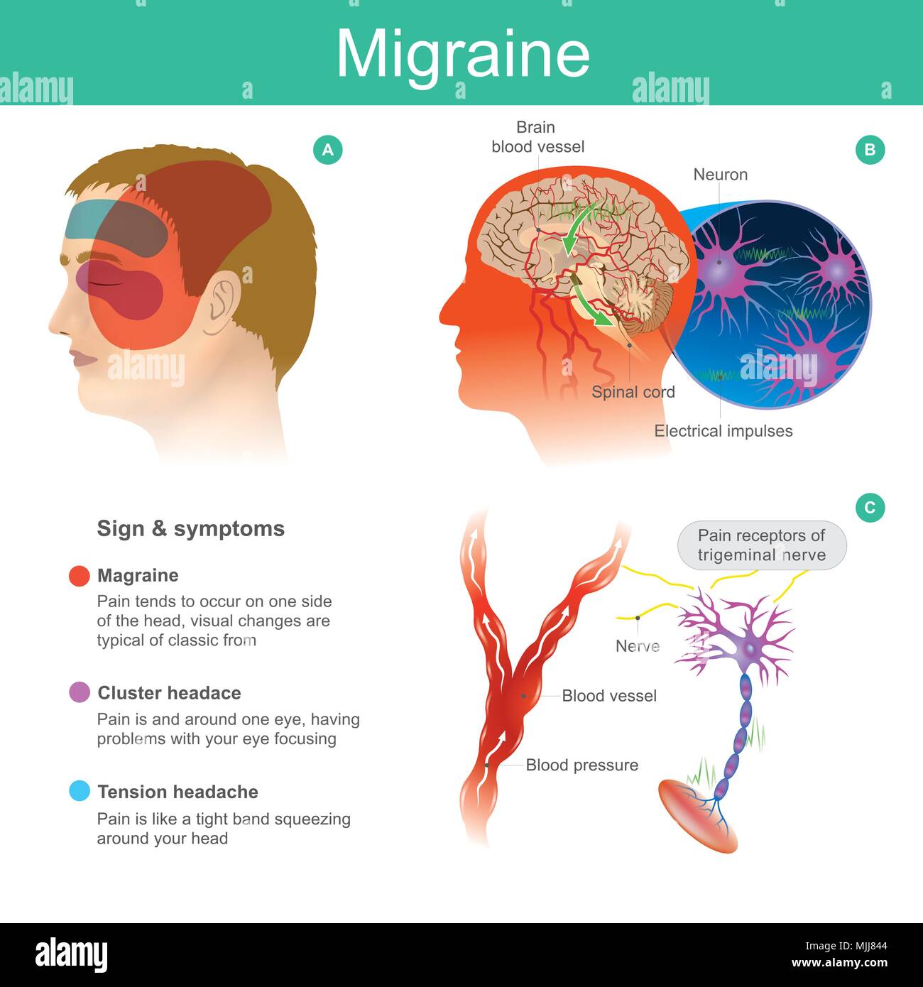 Migraine. Headache, pain, tend cooccur on one side of the head Pressured blood vessels reduce blood flow for brain. Illustration. Stock Vector