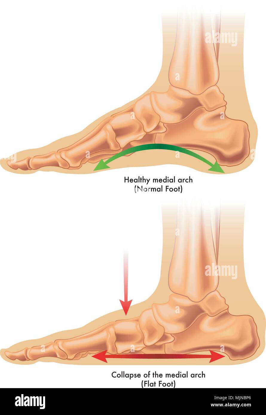 vector medical illustration of the consequences of flat foot Stock Vector