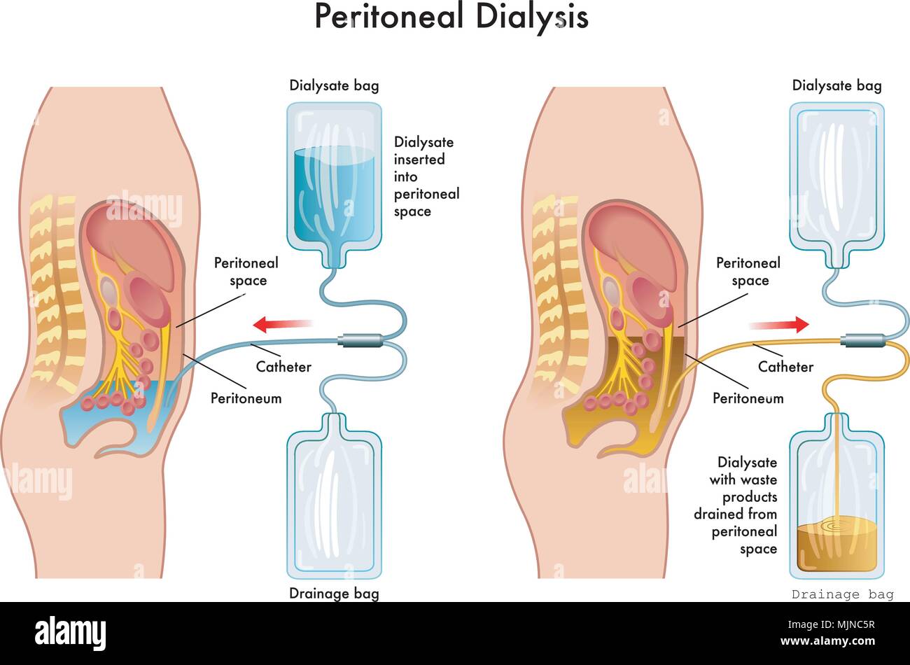 vector medical illustration of  procedure of peritoneal dialysis Stock Vector