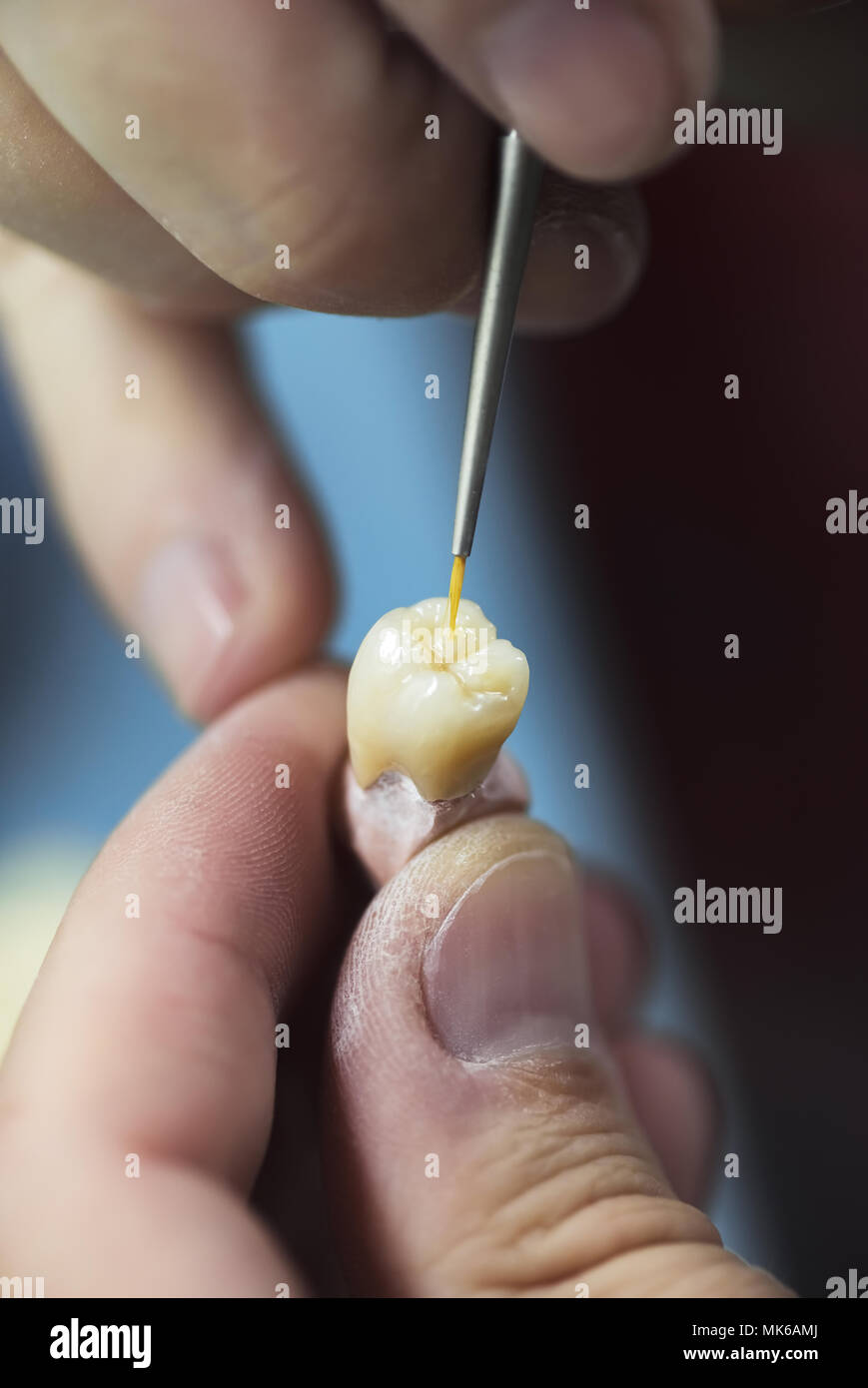 Artificial tooth being done by a dental prosthesis specialist. Stock Photo