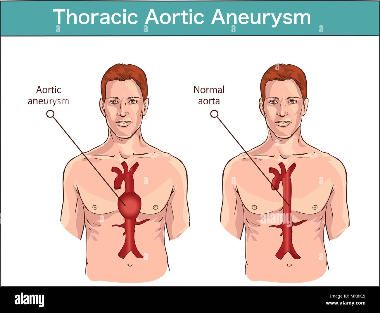 Types Of Abdominal Aortic Aneurysm Normal Aorta And Enlarged
