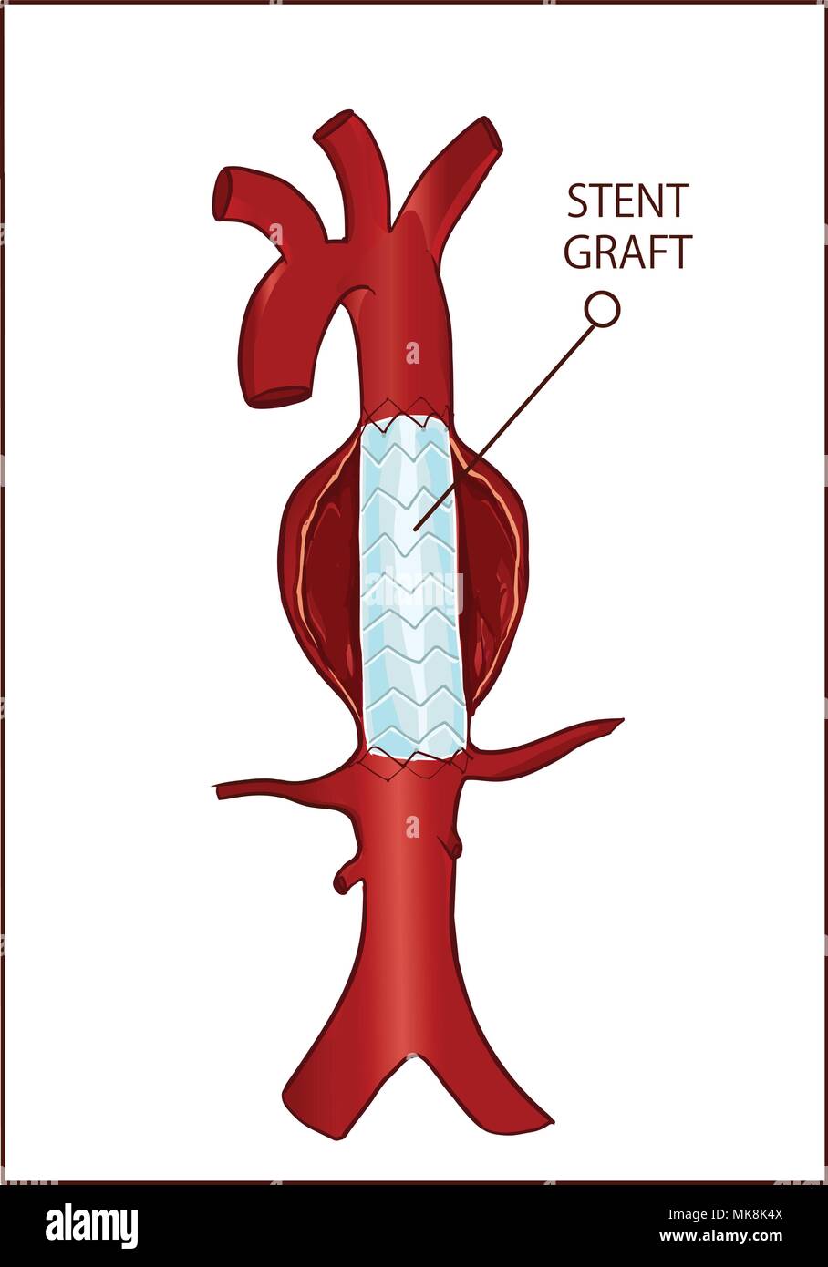 Vector - Thoracic (descending) aortic aneurysm and endovascular surgery Stock Vector