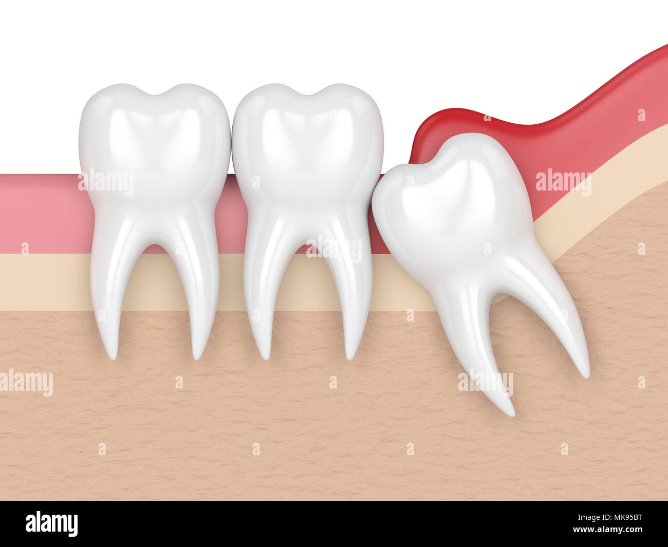3d render of  wisdom mesial impaction with pericoronitis. Concept of different types of wisdom teeth problems. Stock Photo