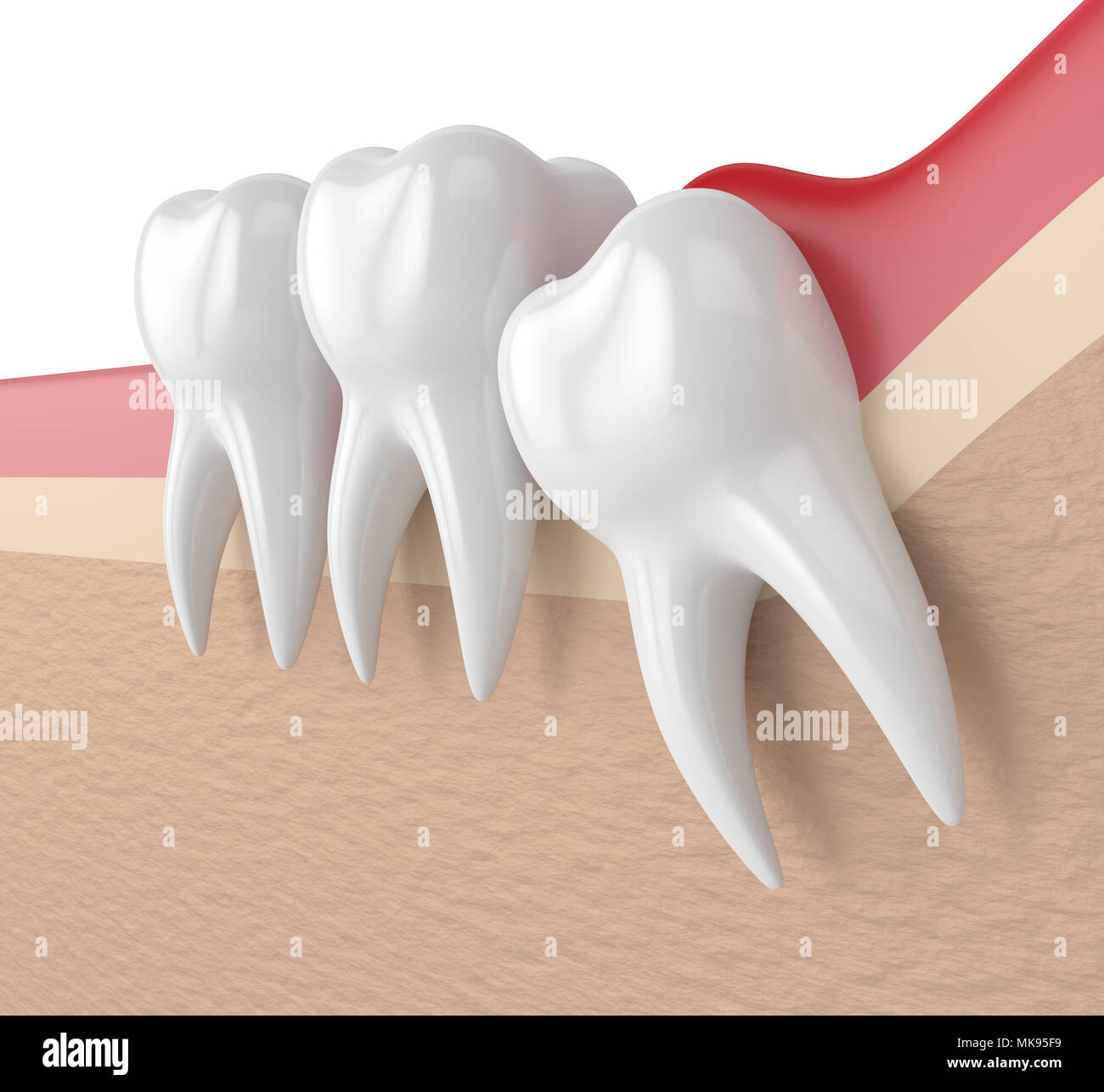 3d render of  wisdom mesial impaction with pericoronitis. Concept of different types of wisdom teeth problems. Stock Photo
