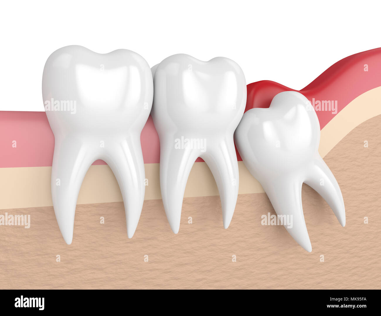 3d render of  wisdom mesial impaction with pericoronitis. Concept of different types of wisdom teeth problems. Stock Photo