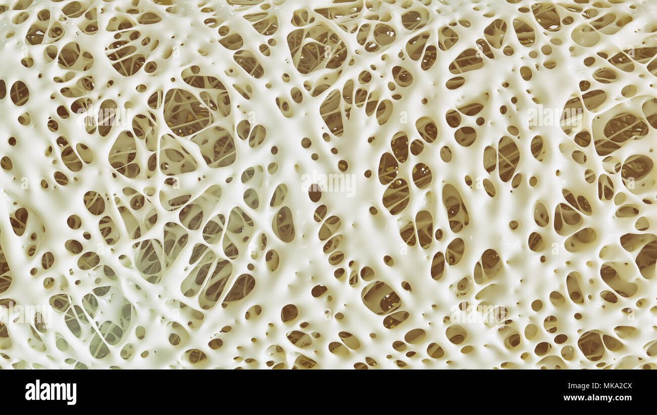Osteoporosis advanced -high details - Stage 4 - 3d rendering Stock ...