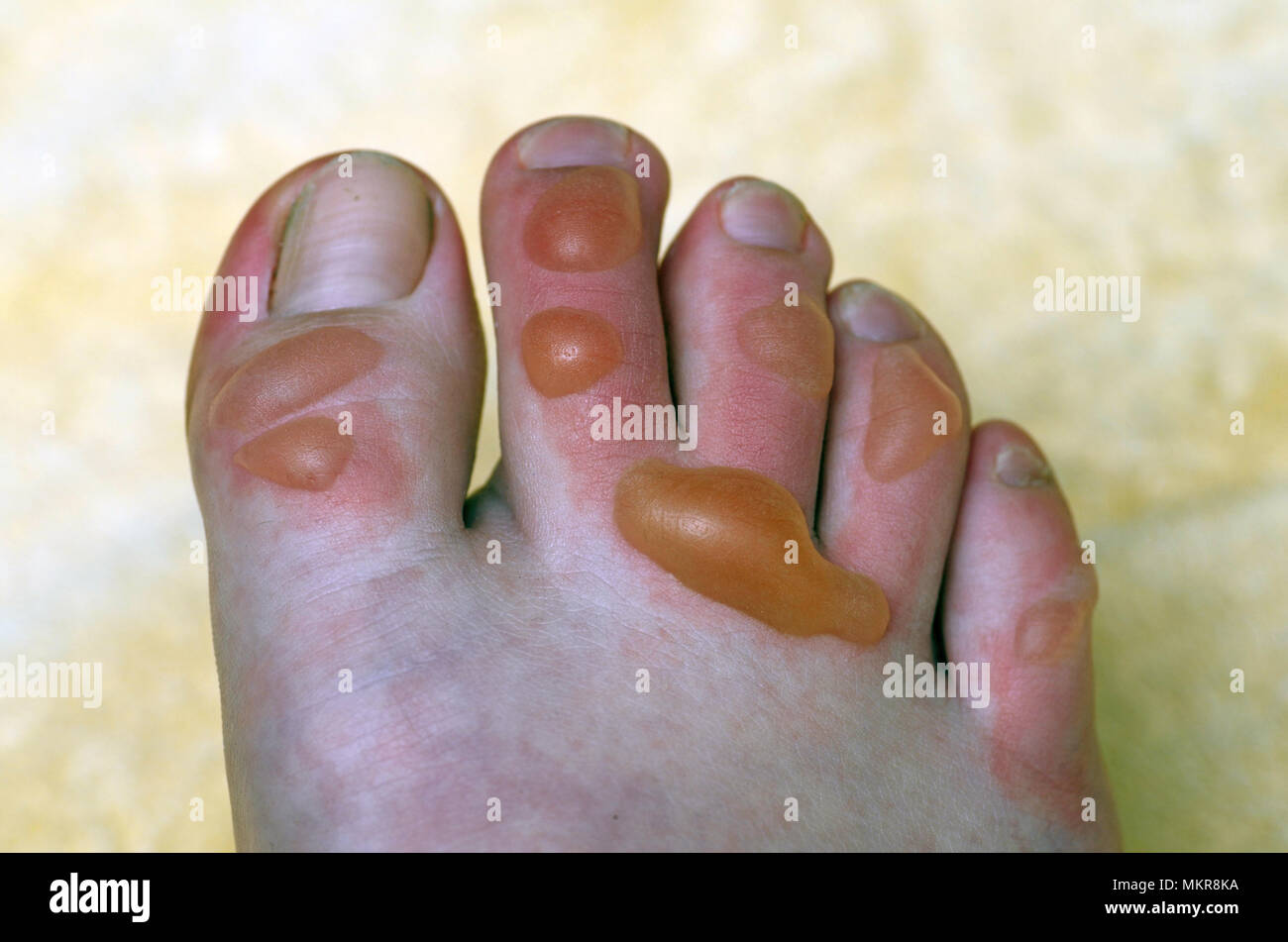 detail of burned and blistered toes Stock Photo