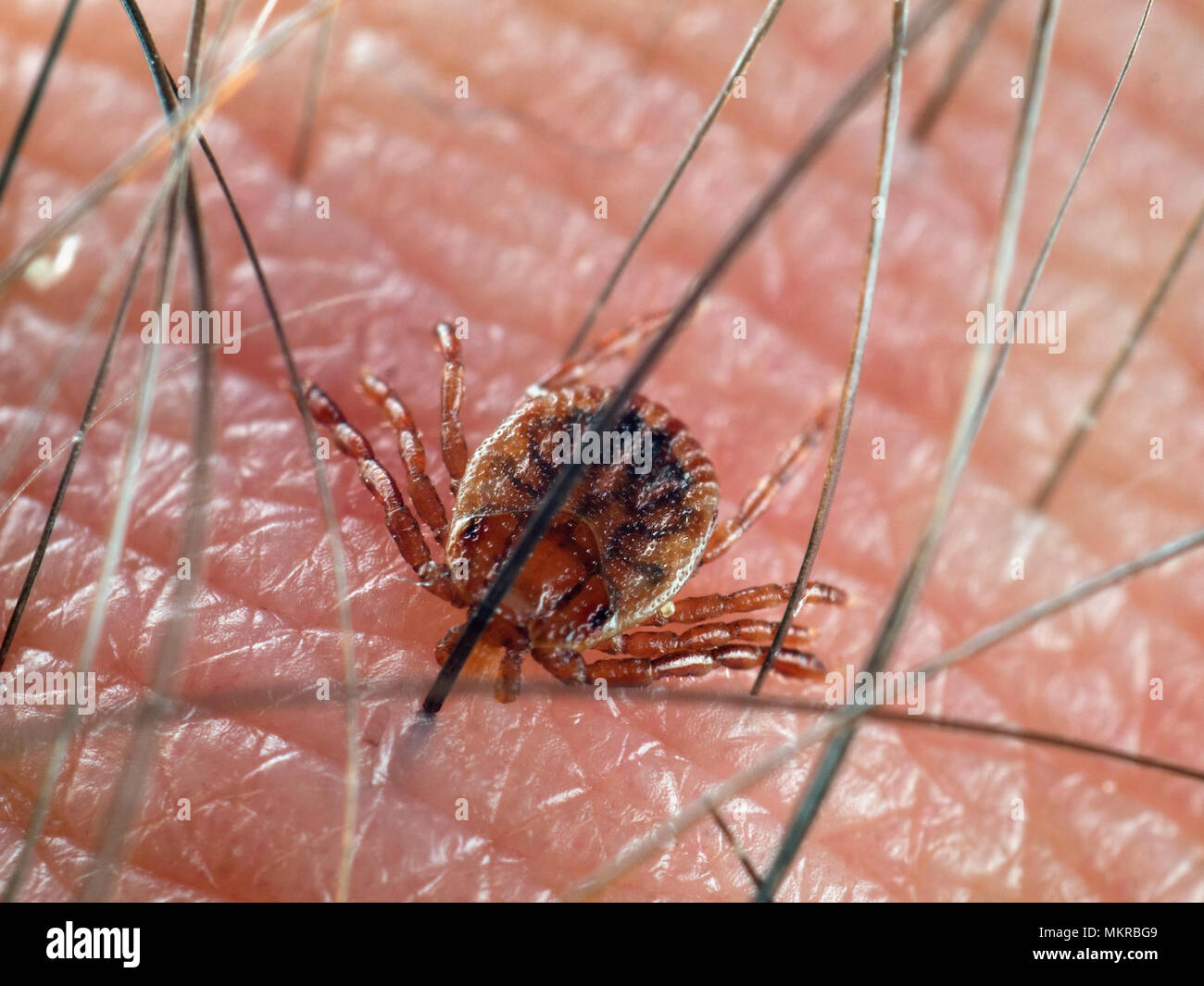 Amblyomma tick biting, lodged on human skin Stock Photo