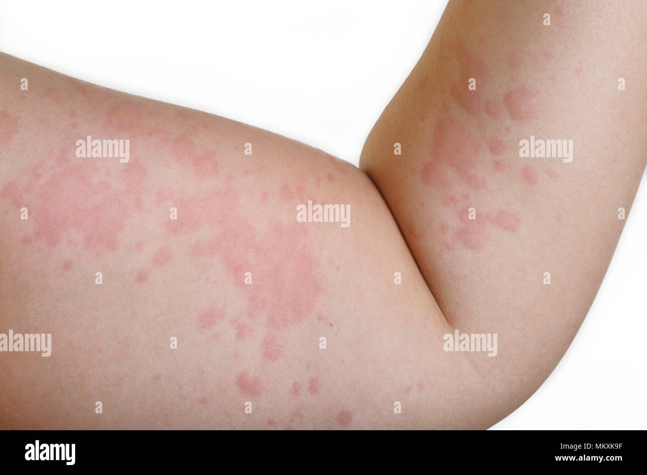Painful rash hi-res stock photography and images - Alamy
