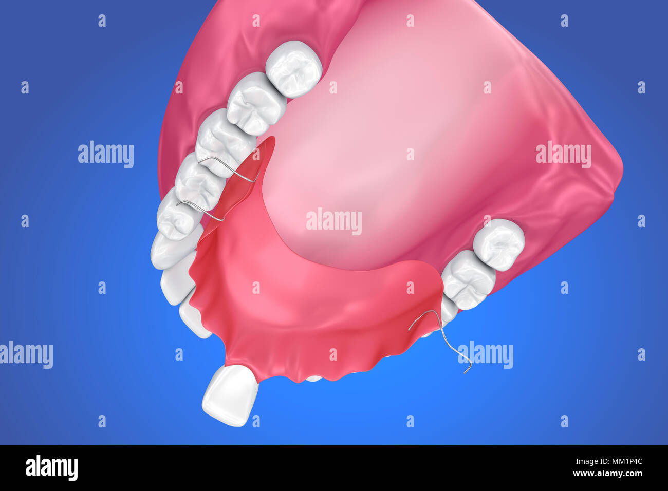 Single Missing Tooth - Removable partial denture . 3D illustration ...