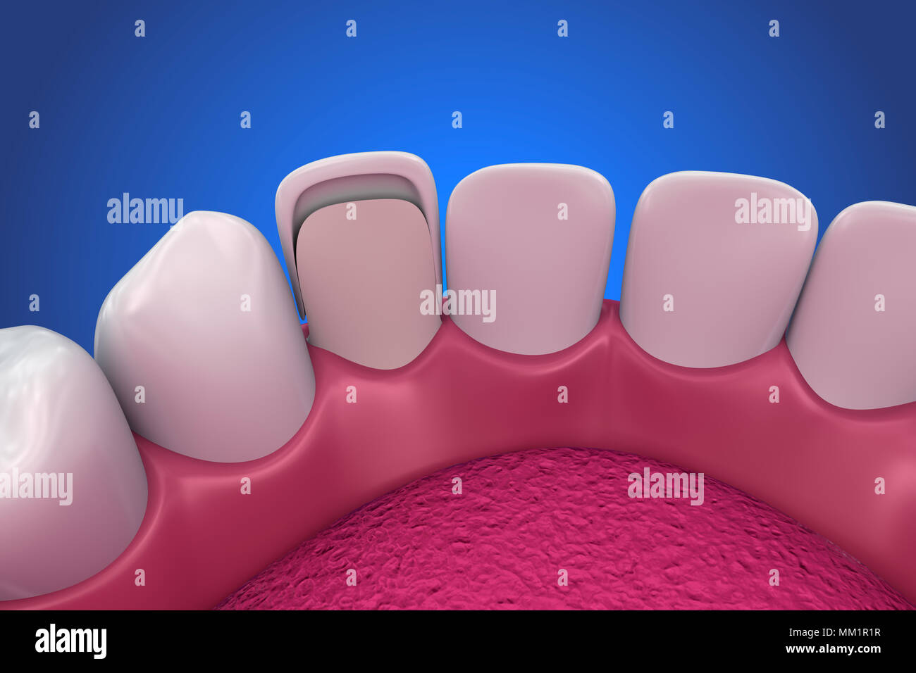 Dental Veneers: Porcelain Veneer installation Procedure. 3D ...