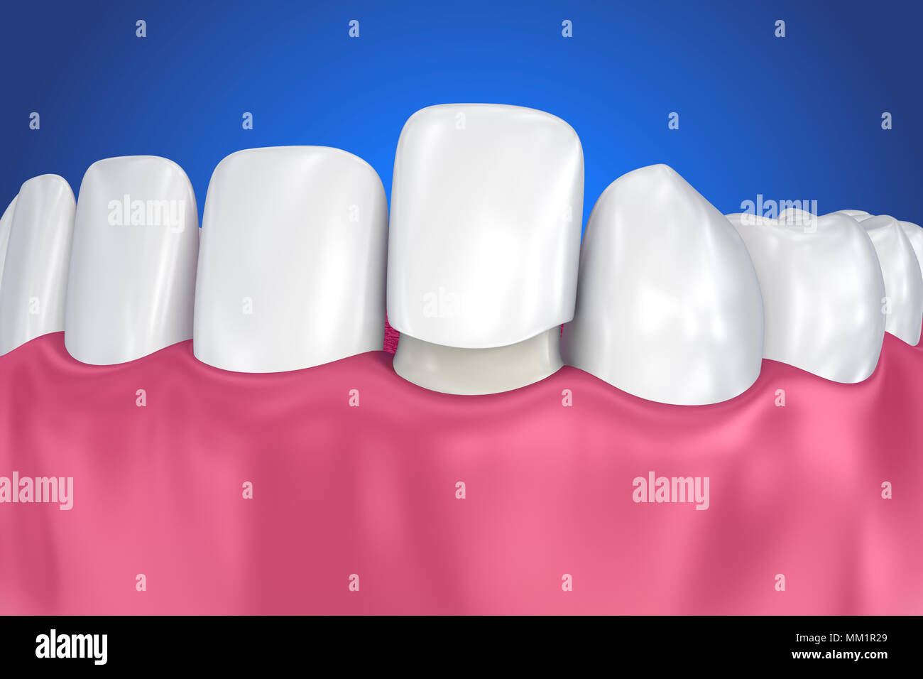 Dental Veneers Porcelain Veneer installation Procedure. 3D