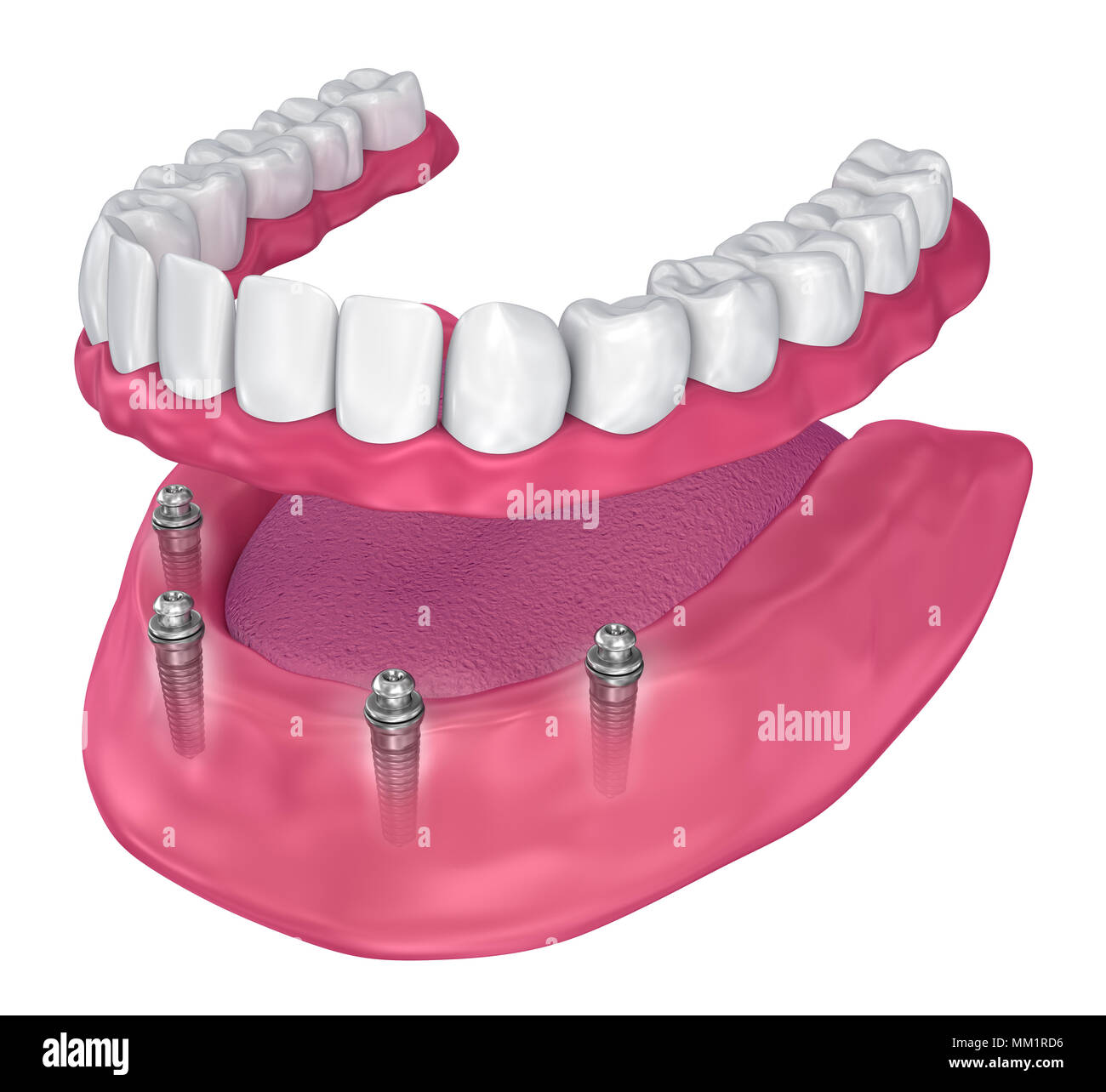 Overdenture to be seated on implants ball attachments. 3D