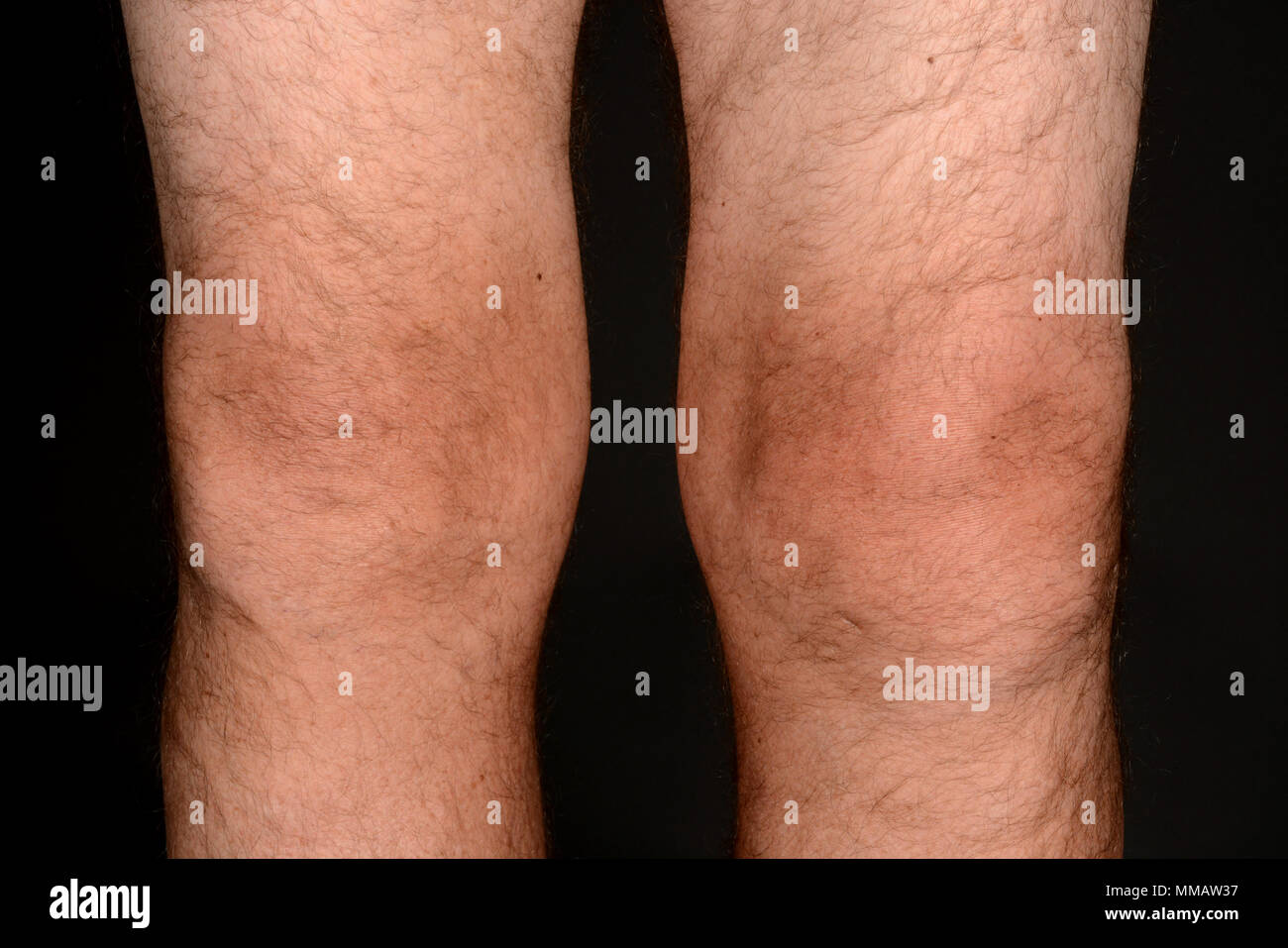 Photograph of arthritis in the knee post op Stock Photo