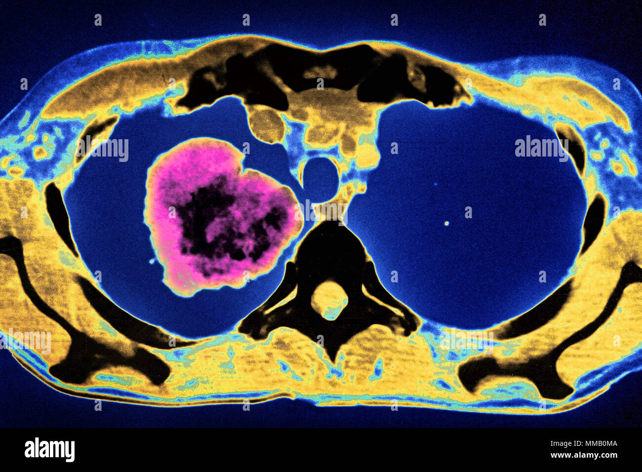 LUNG CANCER, CT SCAN Stock Photo - Alamy