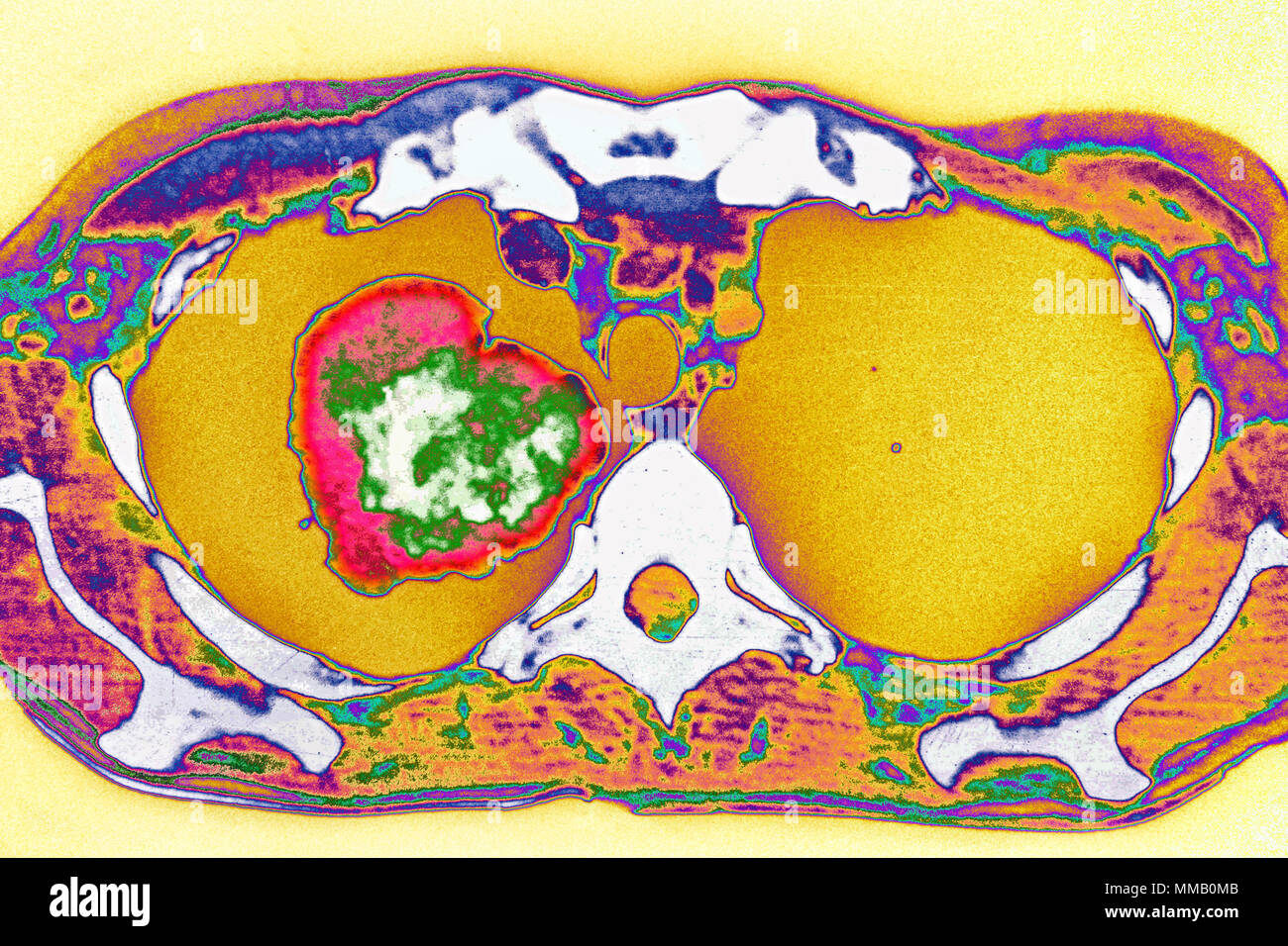 LUNG CANCER, CT SCAN Stock Photo - Alamy