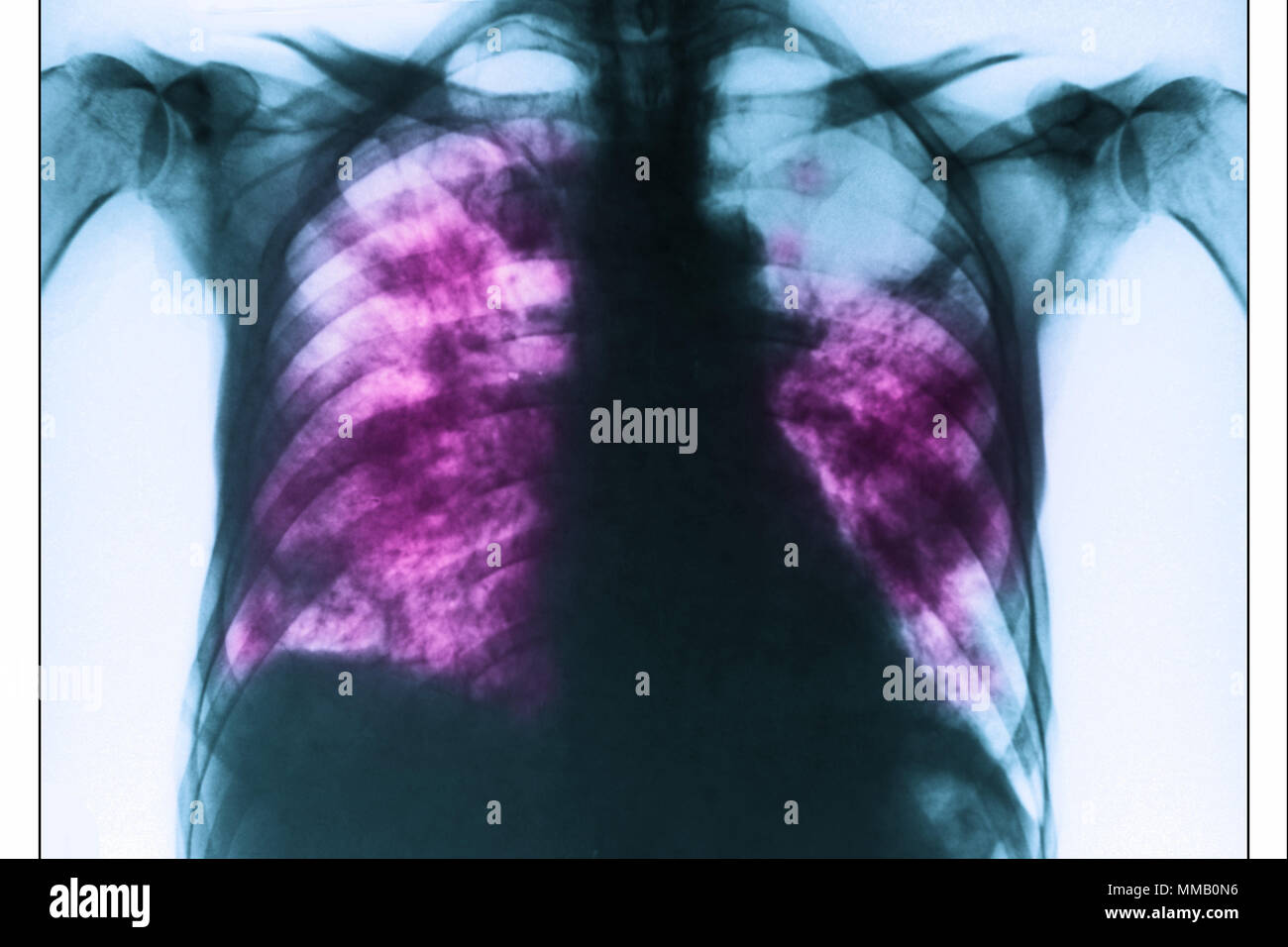 Mycoplasma Pneumoniae Chest X Ray