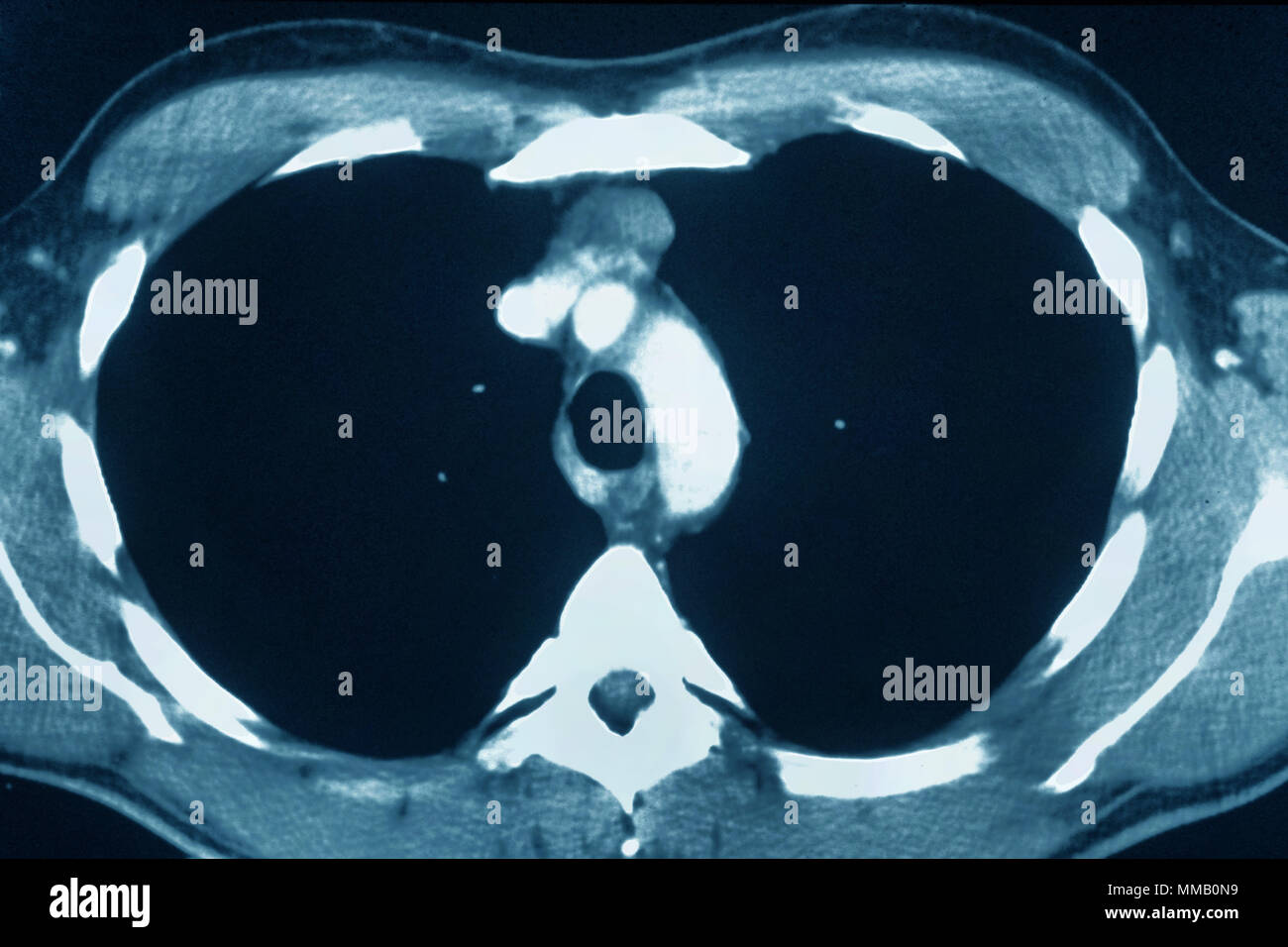 THYMUS CANCER, CT SCAN Stock Photo Alamy
