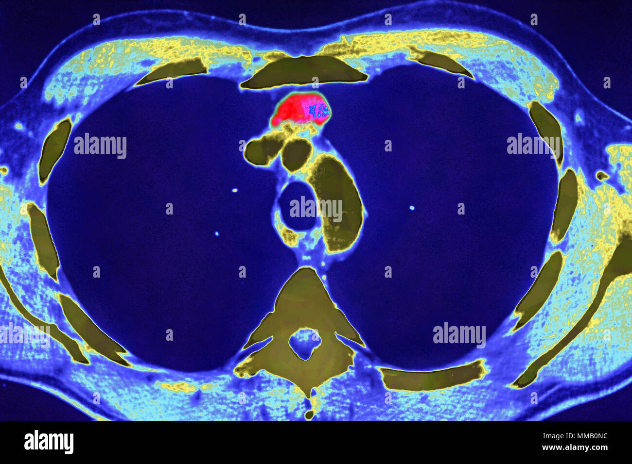 THYMUS CANCER, CT SCAN Stock Photo Alamy