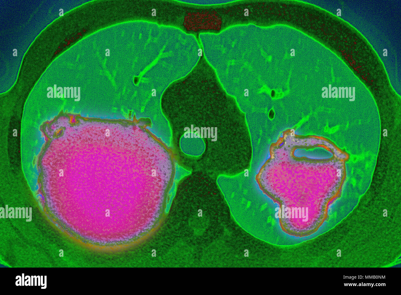 WEGENER'S DISEASE, CT SCAN Stock Photo - Alamy