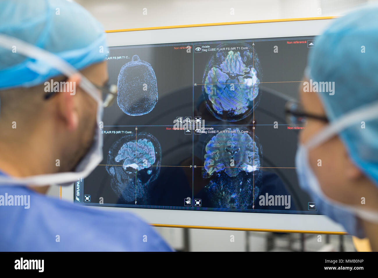 AWAKE BRAIN SURGERY Stock Photo