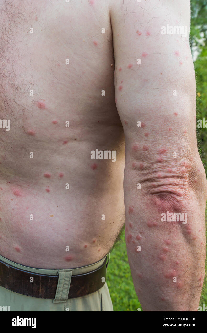 No-see-um bites, which caused itchy red welts, on Lee Rentz in Everglades National Park, Florida, USA Stock Photo