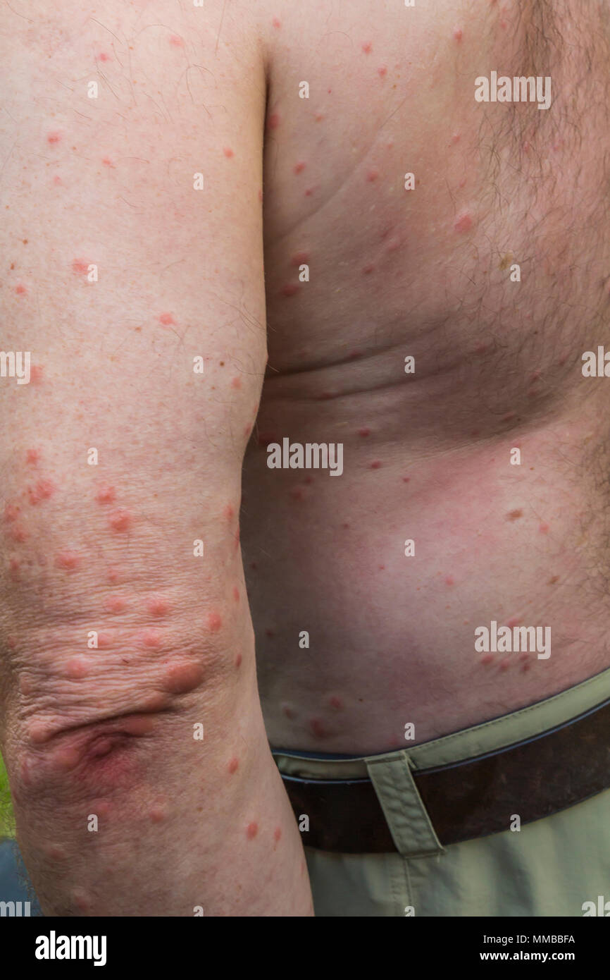 No-see-um bites, which caused itchy red welts, on Lee Rentz in Everglades National Park, Florida, USA Stock Photo