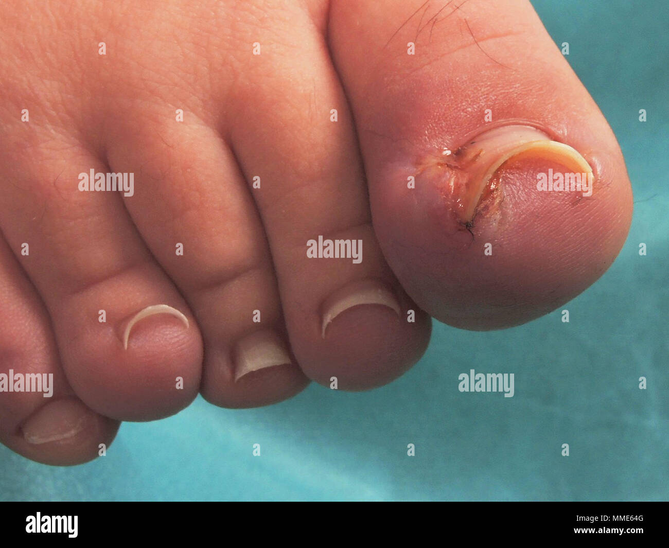 Onychia hi-res stock photography and images - Alamy