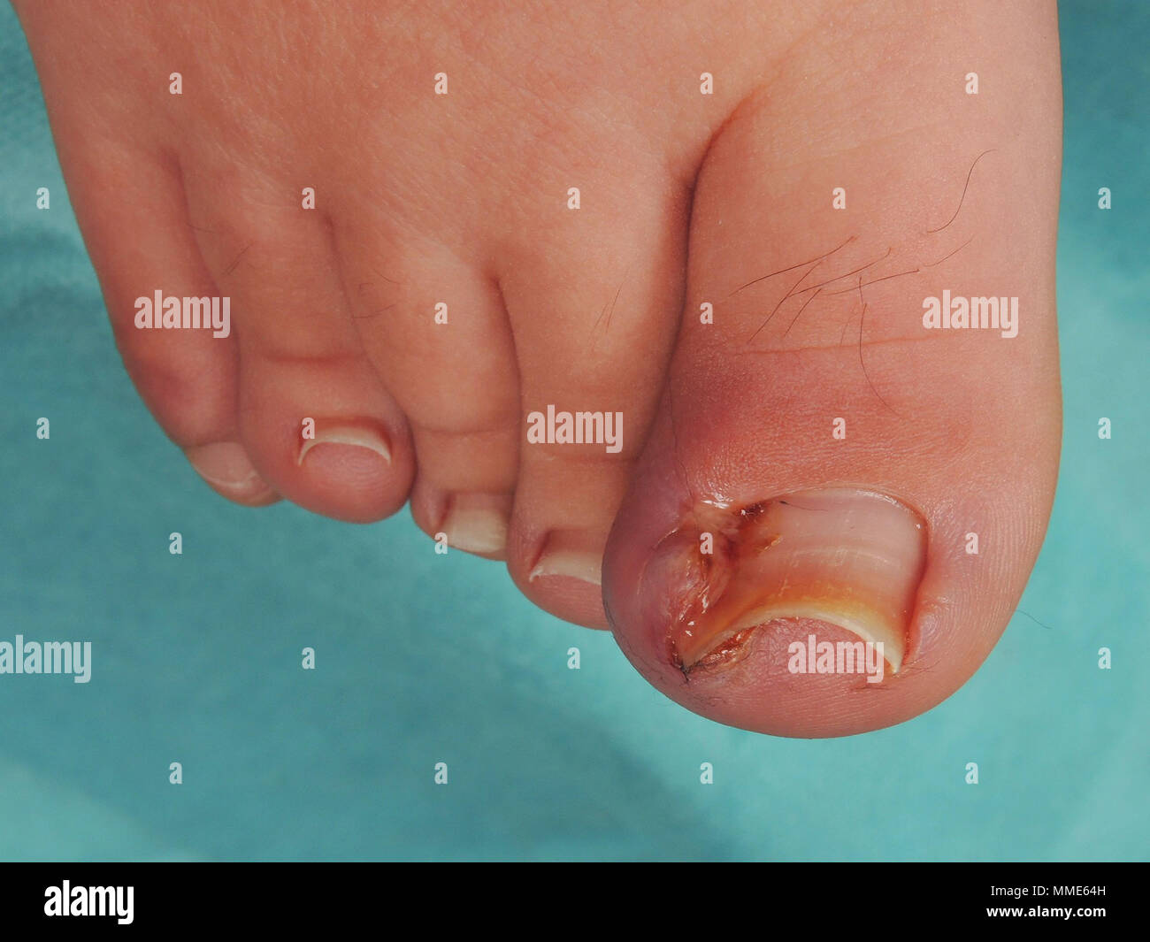 Onychia hi-res stock photography and images - Alamy