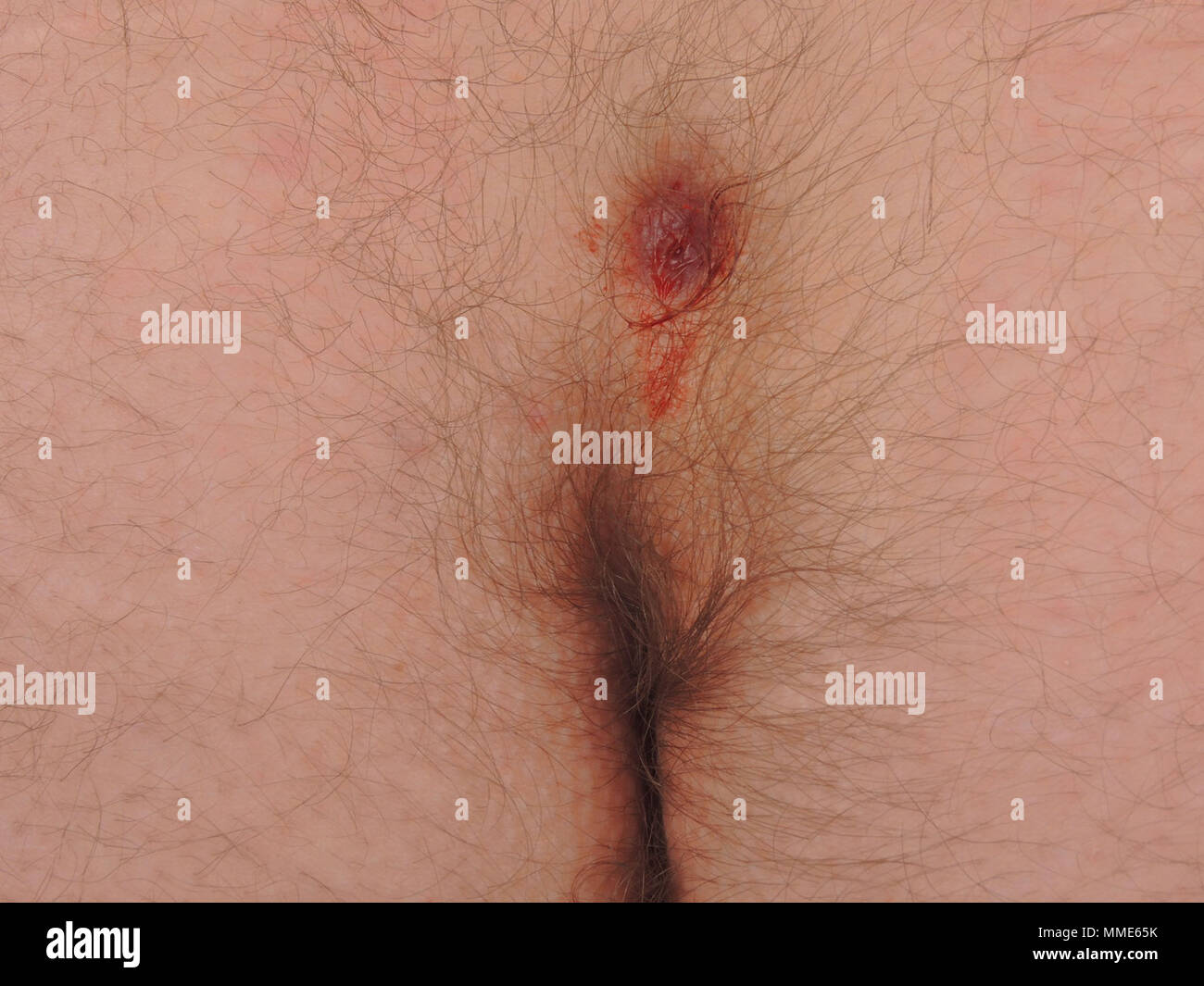 Pilonidal cyst on a man's buttocks - Stock Image - C058/5133 - Science  Photo Library